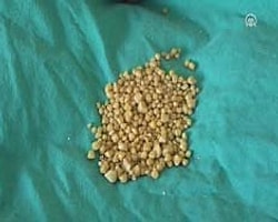 Safra Kesesinden 466 Taş Çıktı-İzleyin