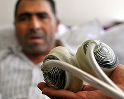 Türkiye'nin İkinci Kalpsiz Hastası!