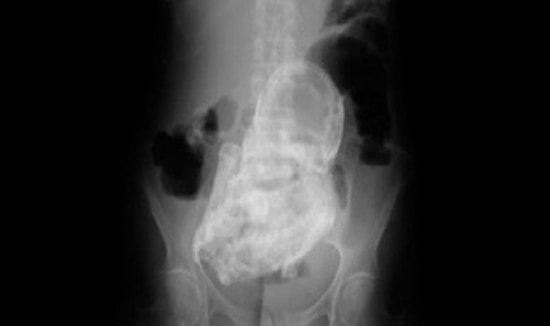 44 Yıldır İçinde Bebek Taşıyor!