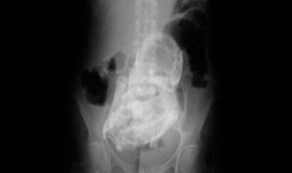 44 Yıldır İçinde Bebek Taşıyor!