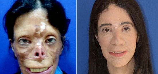 Herkes Nakilsiz Mucizeyi Konuşuyor