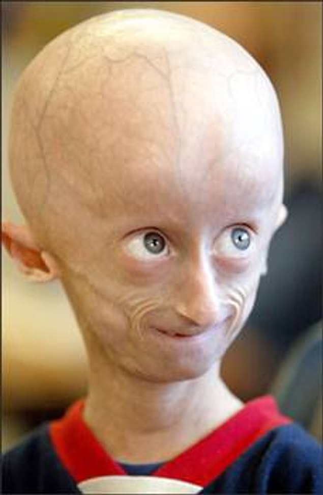 Progeria