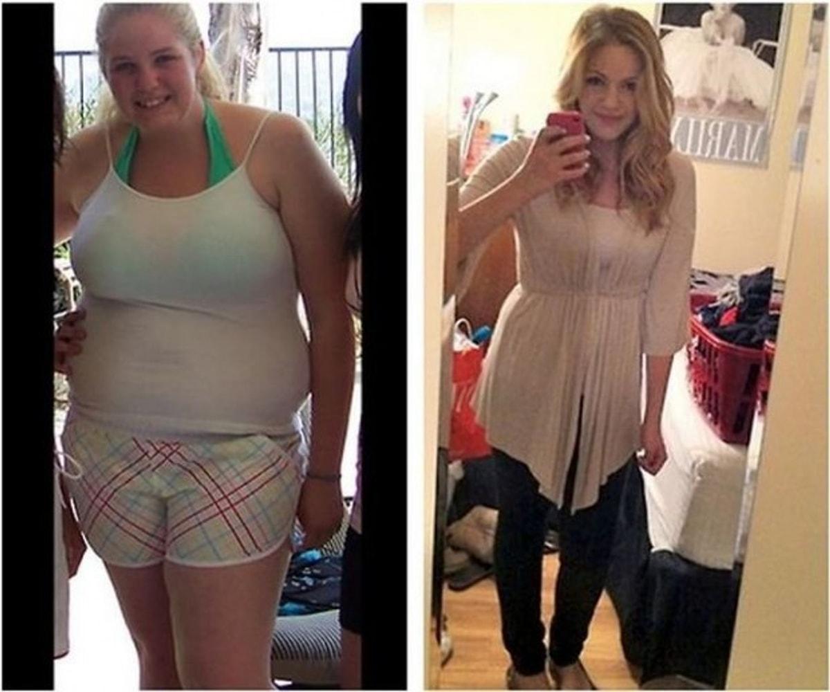 Она сильно похудела. Похудение до и после. До и после похудения девушки. Сильное похудение до и после.