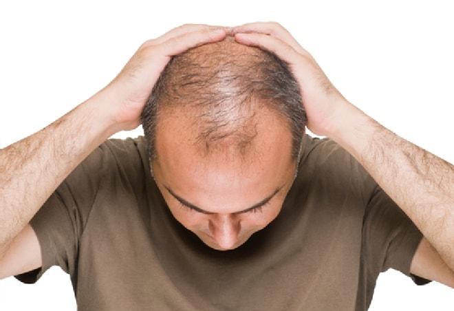 Saç Dökülmesi Nedenleri Nelerdir?