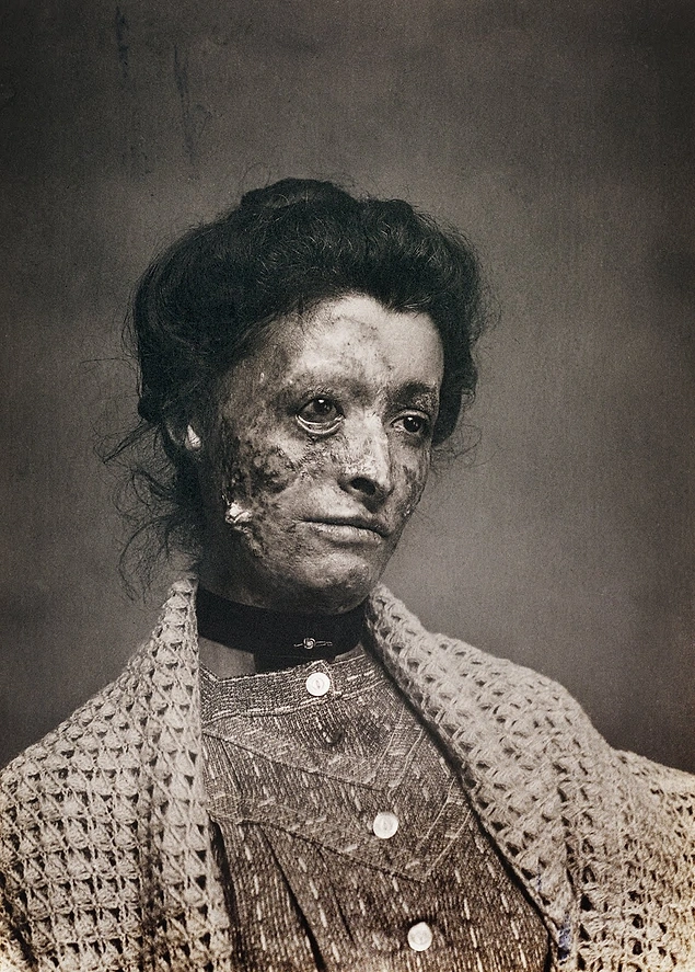 post mortem fotoÄraf nedir ile ilgili görsel sonucu