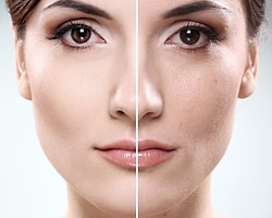 Peeling Nedir ve Ne Zaman Yapılmalıdır?