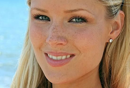 Çil Tedavisi İçin Doğal Yöntemler