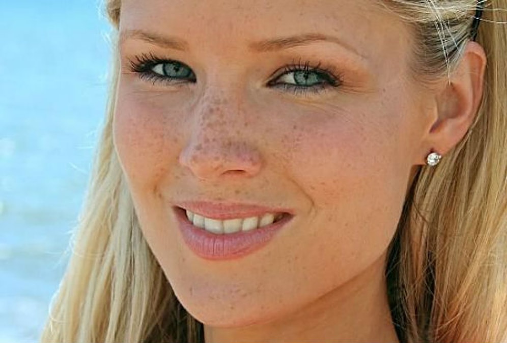 Çil Tedavisi İçin Doğal Yöntemler