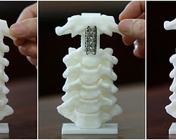 Omurga cerrahisinde dünyanın ilk 3D baskılı omurgası kullanıldı