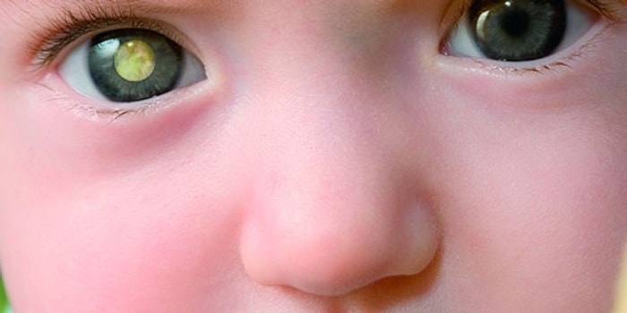 Fotoğraflarda Gözünüz Beyaz Çıkıyorsa Doktora Görünün!