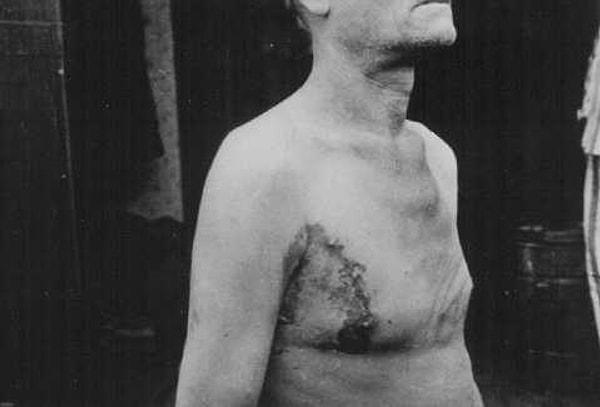 7. Neungamme toplama kampında tüberkülozla ilgili tıbbî deneylere tabi tutulan Sovyet savaş esiri.