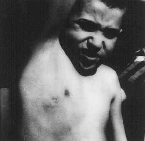 8. SS doktorları lenf düğümlerini çıkardıktan sonra kalan yarayı göstermeye zorlanan Yahudi çocuk. Bu çocuk tıbbî deneyin bir parçası olarak tüberküloz mikrobu verilen 20 Yahudi çocuktan biriydi. Hepsi 20 Nisan 1945'te öldürüldü.
