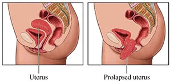 30. Vajina düşmesi, sarkması gerçekleşebilen bir organdır. Bu sarkmalara Pelvic organ prolapse denir.