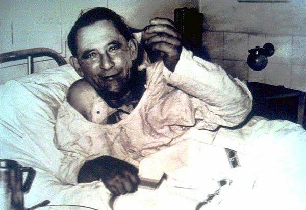 17. Tarihte ilk kalp nakli yapılan insan, Louis Washkansky. Fotoğraf, 6 Aralık 1967 tarihinde, ameliyattan üç gün sonra çekilmiş.