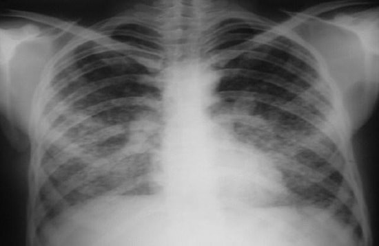 Silikozis Bir Can Daha Aldı