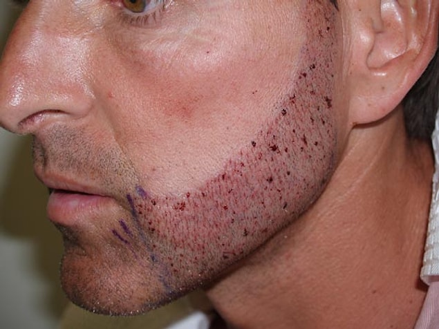 1. Beard & moustache implant