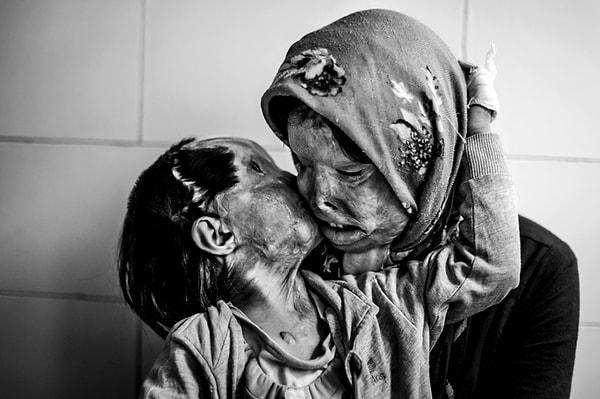 13. Evin babası tarafından asit saldırısına uğrayan anne ve üç yaşındaki kızı kucaklaşıyor.