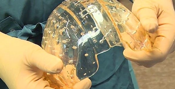 2. Череп изготовленный при помощи трехмерного принтера удалось пересадить человеку.