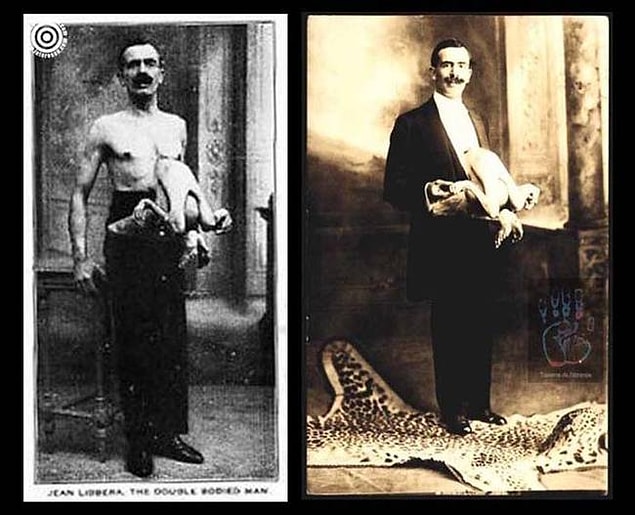 Jean bu konuda özel bir örnek. O'nun vücudunda parazit olarak yaşayan ve göğsünden bağlı bir ikizi vardı.