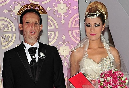 Yüz Nakli Yapılan Recep Sert Dünyaevine Girdi