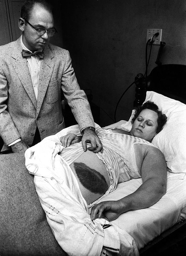 5. Moody Jacobs oldukça büyük bir yarayı gösterirken. Ann Hodges, göktaşı çarpan tek kadın olarak tarihe geçmiştir, 1954.