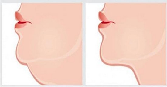 İstenmeyen Gıdıdan Kurtulmak İçin En İyi Egzersizler