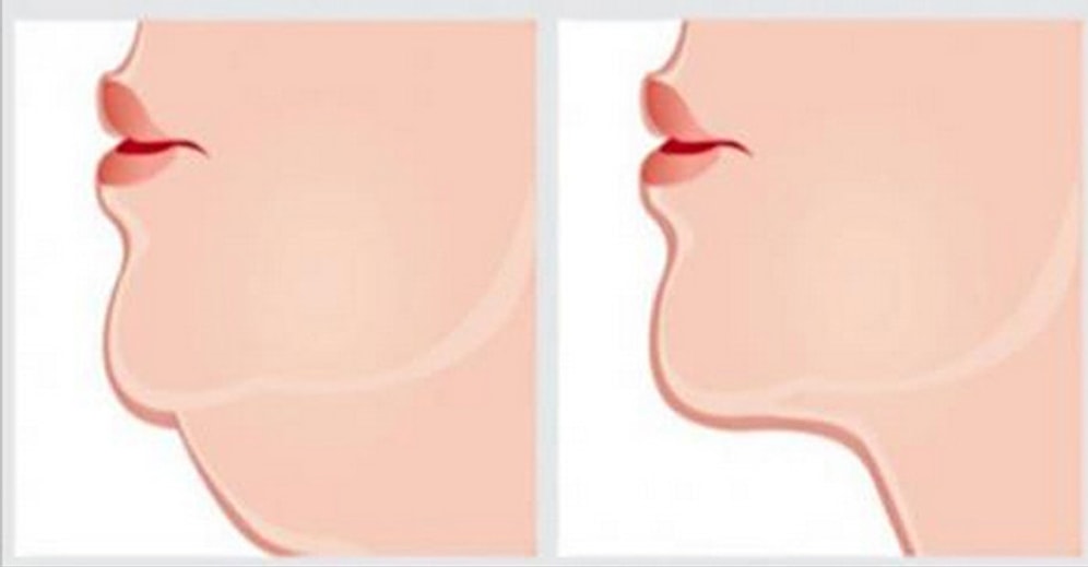 İstenmeyen Gıdıdan Kurtulmak İçin En İyi Egzersizler