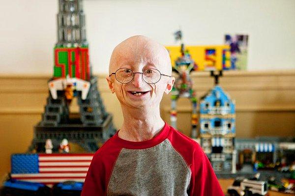 1. Bu hastalığın en belirgin etkisi çocukların görünüşleri üzerinde. Progeria olan bir çocuk sanki 80 yaşına gelmiş bir insan gibi görünüyor.
