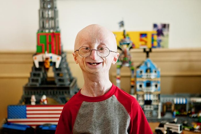 Çocukların Hayatını Mahveden Hastalık: Progeria ile Mücadele Eden 15 İnançlı Çocuk