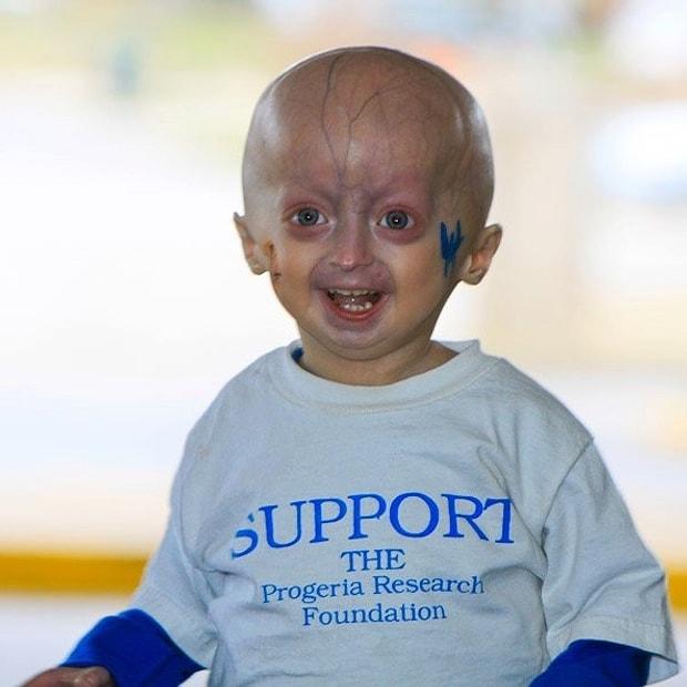 Cocuklarin Hayatini Mahveden Hastalik Progeria Ile Mucadele Eden 15 Inancli Cocuk