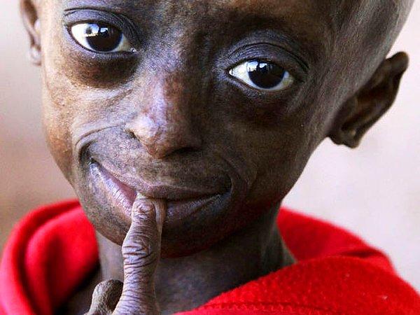 11. Progeria din, dil, ırk ve mezhep ayrımı yapmaksızın çocukların hayatını mahvediyor.