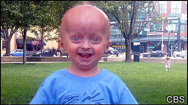 12. Progeria Araştırma Kurumu'nun verdiği bilgilere göre, günümüzde dünyada 124 progerialı yaşayan çocuk bulunuyor ve bu çocuklardan bir tanesi Türkiye'de.