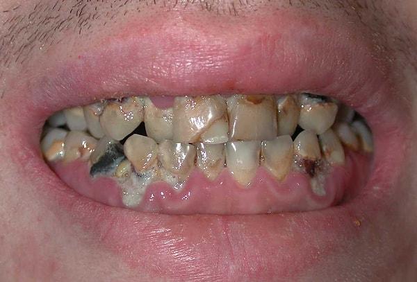 Dünyanın En Yaygın Hastalığı Diş Çürüğüdür