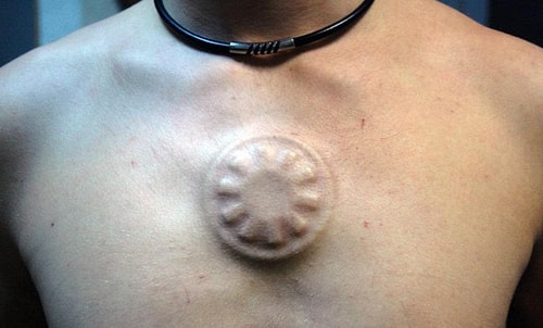 Deri altı implantı