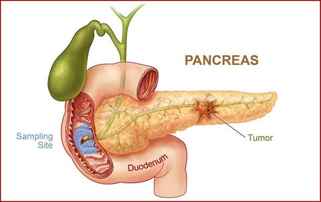 8. Pankreas kanseri