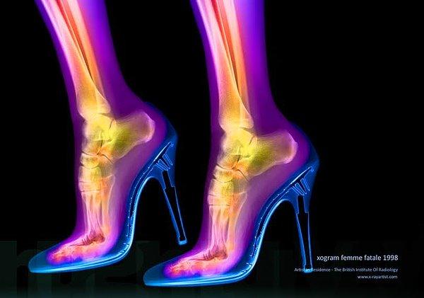 Bu fotoğrafta, yüksek topukların üzerindeki kemiklerin keskin ve doğal olmayan açısını görebilirsiniz. Gerçekten anormal olan bu görüntü, her gün yüksek topuklu ayakkabı giymeyi sizlere bir kez daha düşündürebilir.