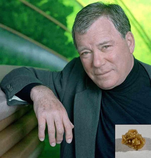 14. William Shatner'ın böbrek taşı - 25.000 $