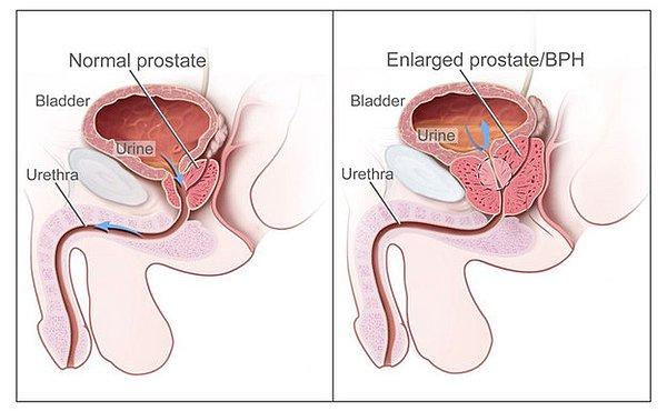 11. Erkek olarak dünyaya geldiyseniz, yaşlandığınızda prostatla ilgili bazı sıkıntılar yaşamanız muhtemel.