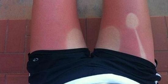 Tatilinizi Zehir Edecek Güneş Yanıklarını İyileştirmenin 11 Yolu