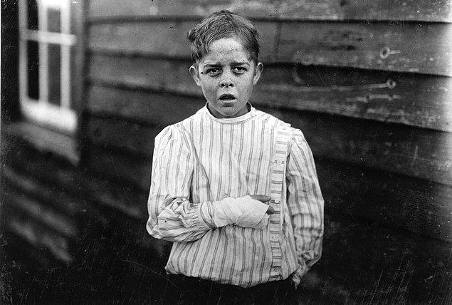17. Bir fabrikada çalışan Giles Edmund Newsom isimli yaralı çocuk işçi. Hikayesi ise şöyle: Giles fabrikada çalışırken bir makine parçası ayağına düşüyor  ve ayak parmağını eziyor. Bu da dengesini kaybedip bir makineye elini kaptırmasına ve iki parmağının kopmasına sebep oluyor.(1912)