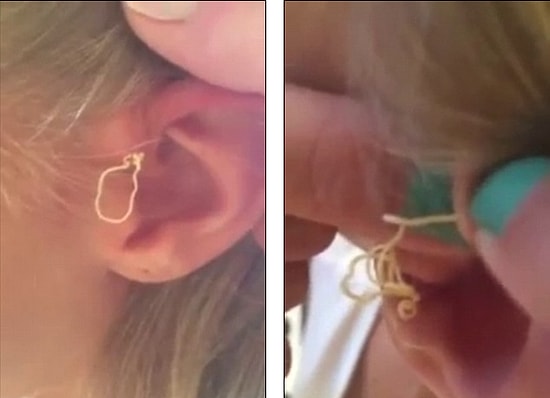 11 Yaşındaki Kız 6 Yıldır Kulağında Taşıdığı Sivilceyi Sıkmaya Başlarsa