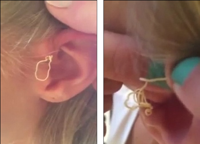 11 Yaşındaki Kız 6 Yıldır Kulağında Taşıdığı Sivilceyi Sıkmaya Başlarsa