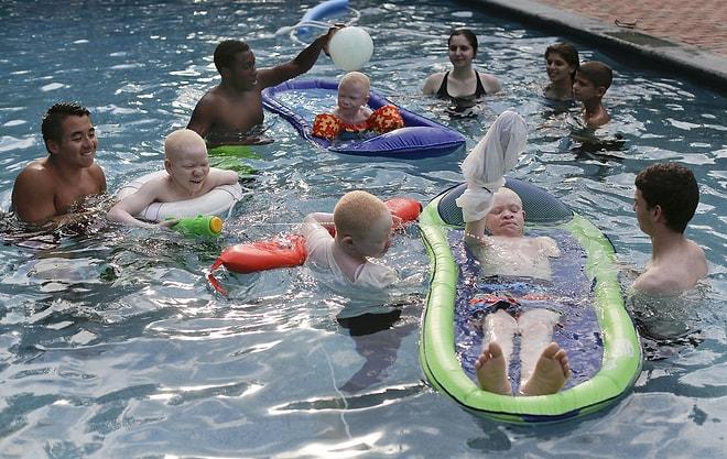 Ölüm Tehlikesiyle Yaşayan Albino Hastası Çocuklar New York'ta Mutlu Sona Kavuştu!