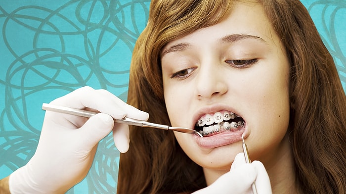 Hayatının Bir Kısmında Diş Teli Takan İnsanların Anlayacağı Durumlar