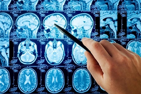 Parkinson, Beyin Hücrelerini Aşırı Isıtarak Öldürüyor