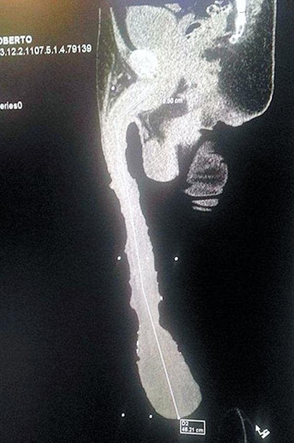 Meksika'nın Coahuila eyaletinde yaşayan Roberto'nun X-ray görüntüsü.