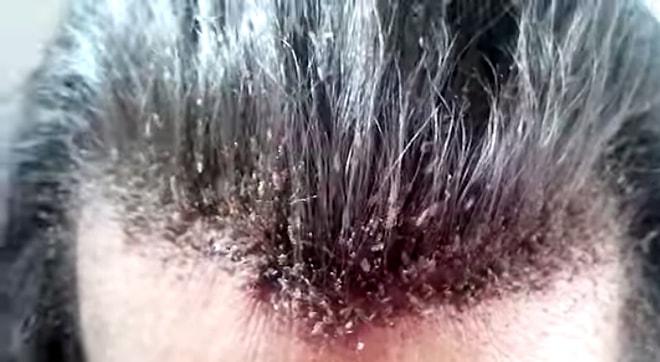 Bu Video Saç Yıkatır: Saç Biti İstilasına Uğrayan Adamın İnsanı Kaşındıran Görüntüleri