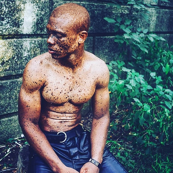 Albino Modelin Başlattığı Kampanya Her Cildin Güzel Olduğunu Kanıtlıyor