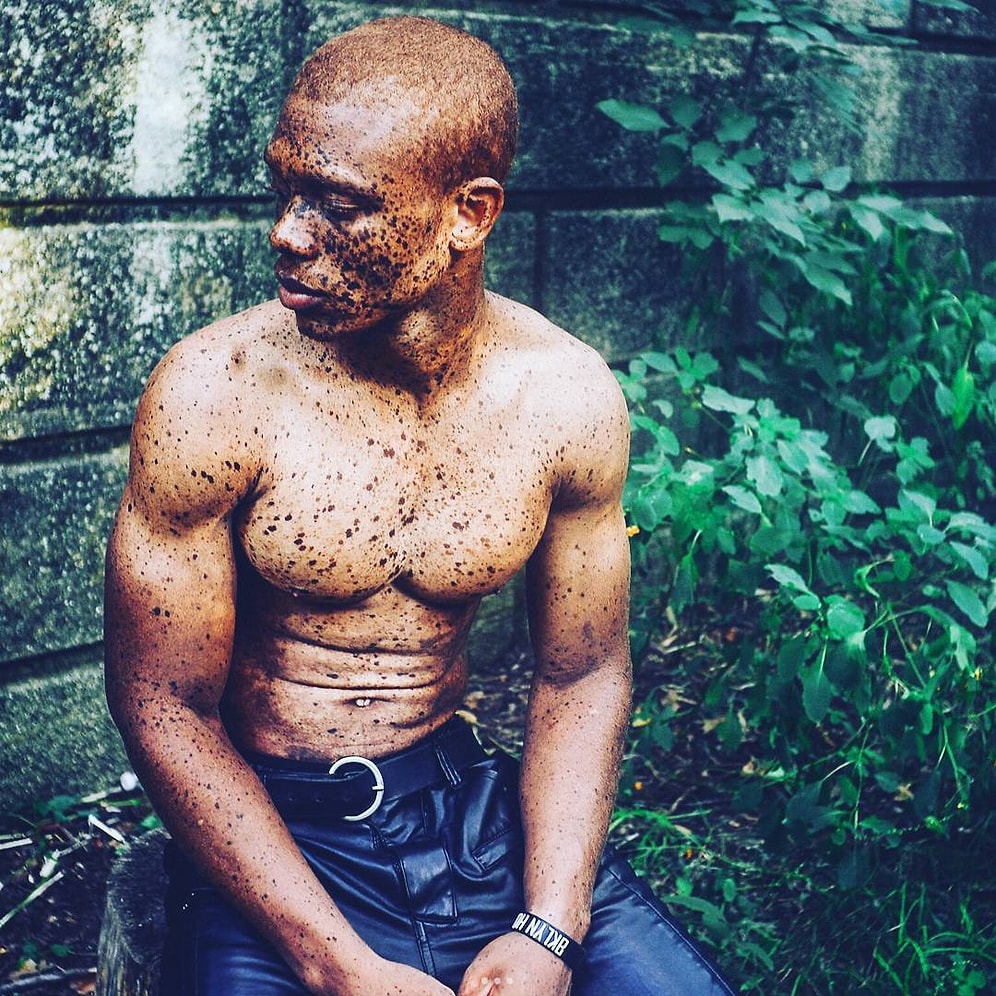 Albino Modelin Başlattığı Kampanya Her Cildin Güzel Olduğunu Kanıtlıyor