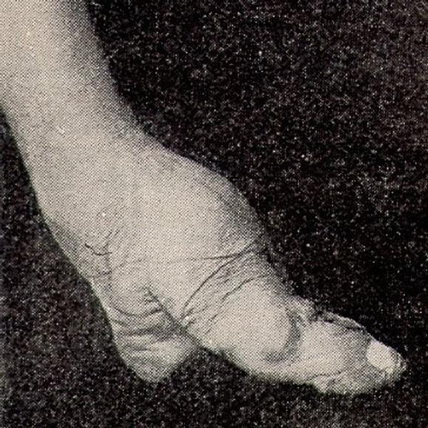 Parmaklar ve kemikler baskıdan dolayı kırılıyor. Ayakların mümkün olduğu kadar küçük kalabilmesi için, bandajlar devamlı olarak daha fazla sıkılıyor.